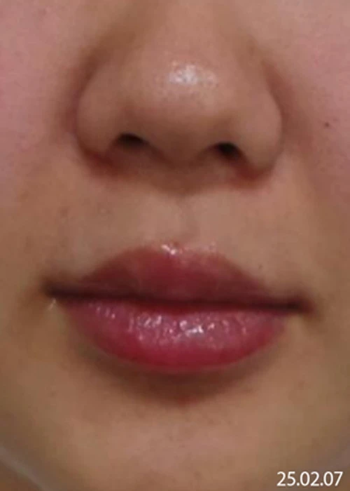 Before