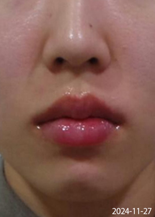 Before