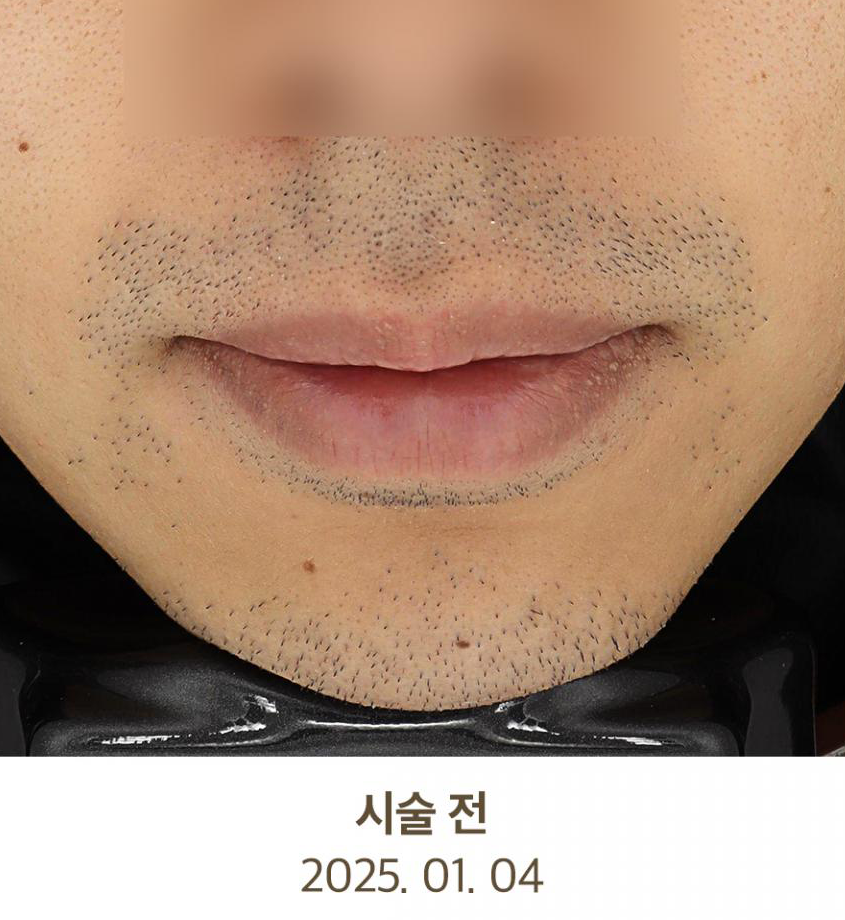 Before