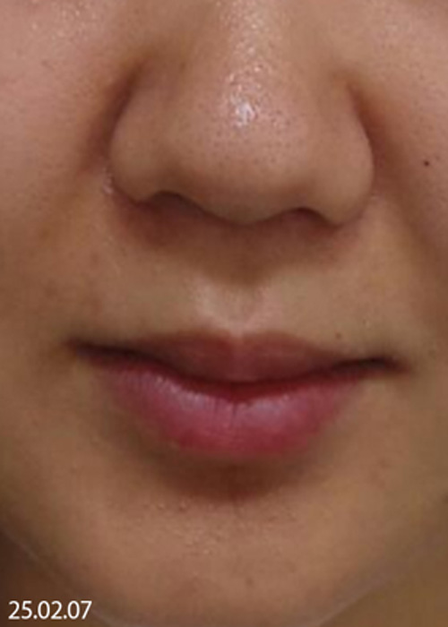 Before