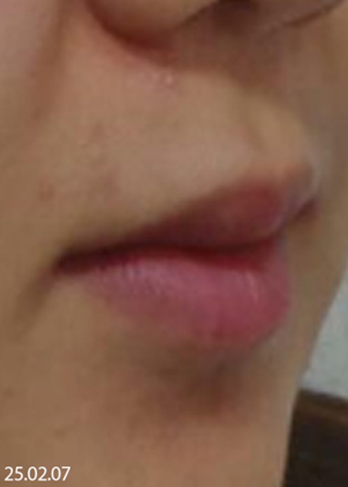 Before