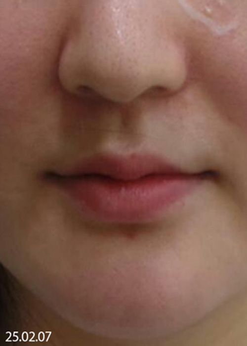 Before