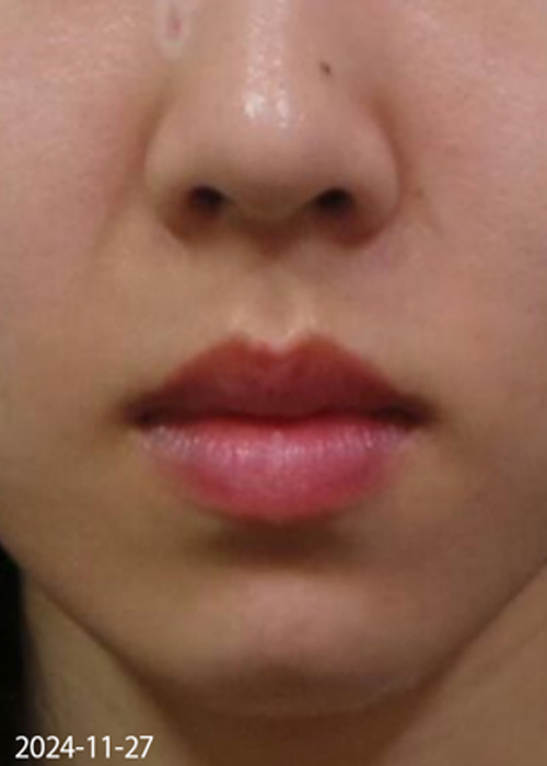 Before