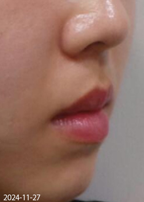 Before