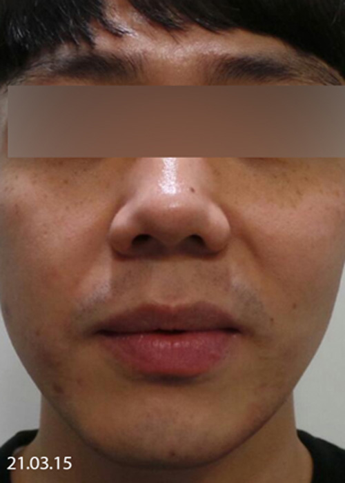 Before