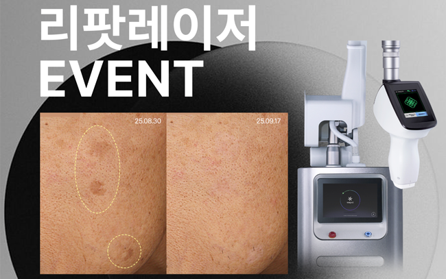 리팟레이저 이벤트